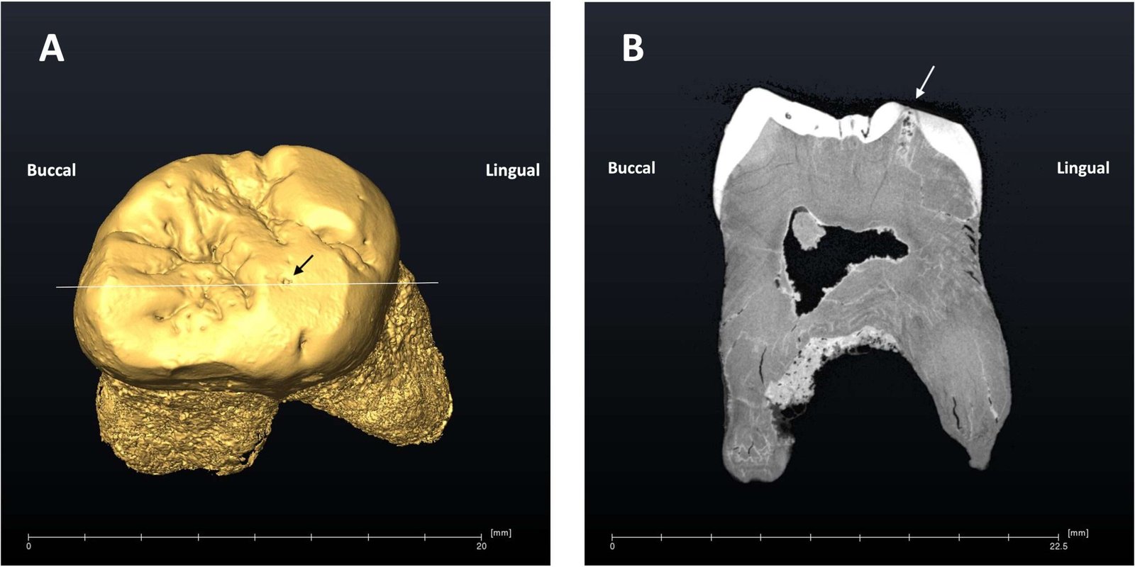 El uso de la boca como una tercera mano pudo causar la última caries descubierta en un fósil neandertal